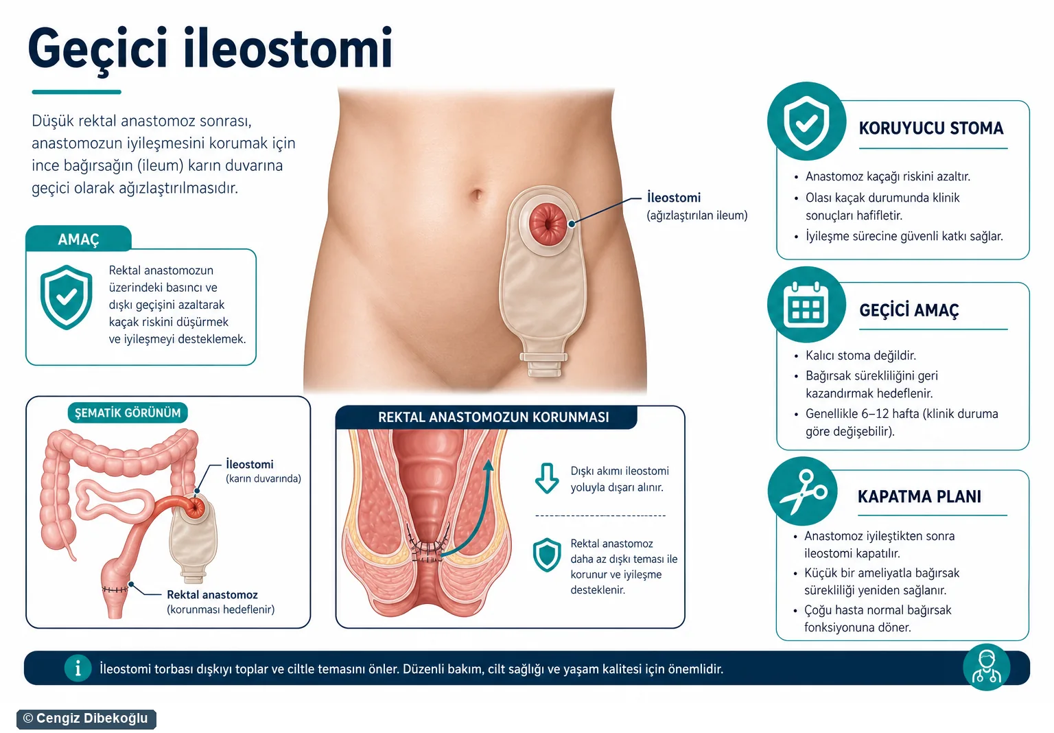 Geçici ileostomi 3D