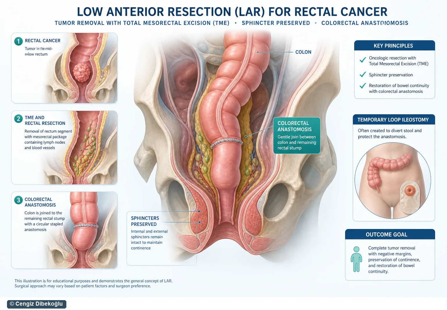 3D şema: low anterior rezeksiyon sonrası fonksiyon