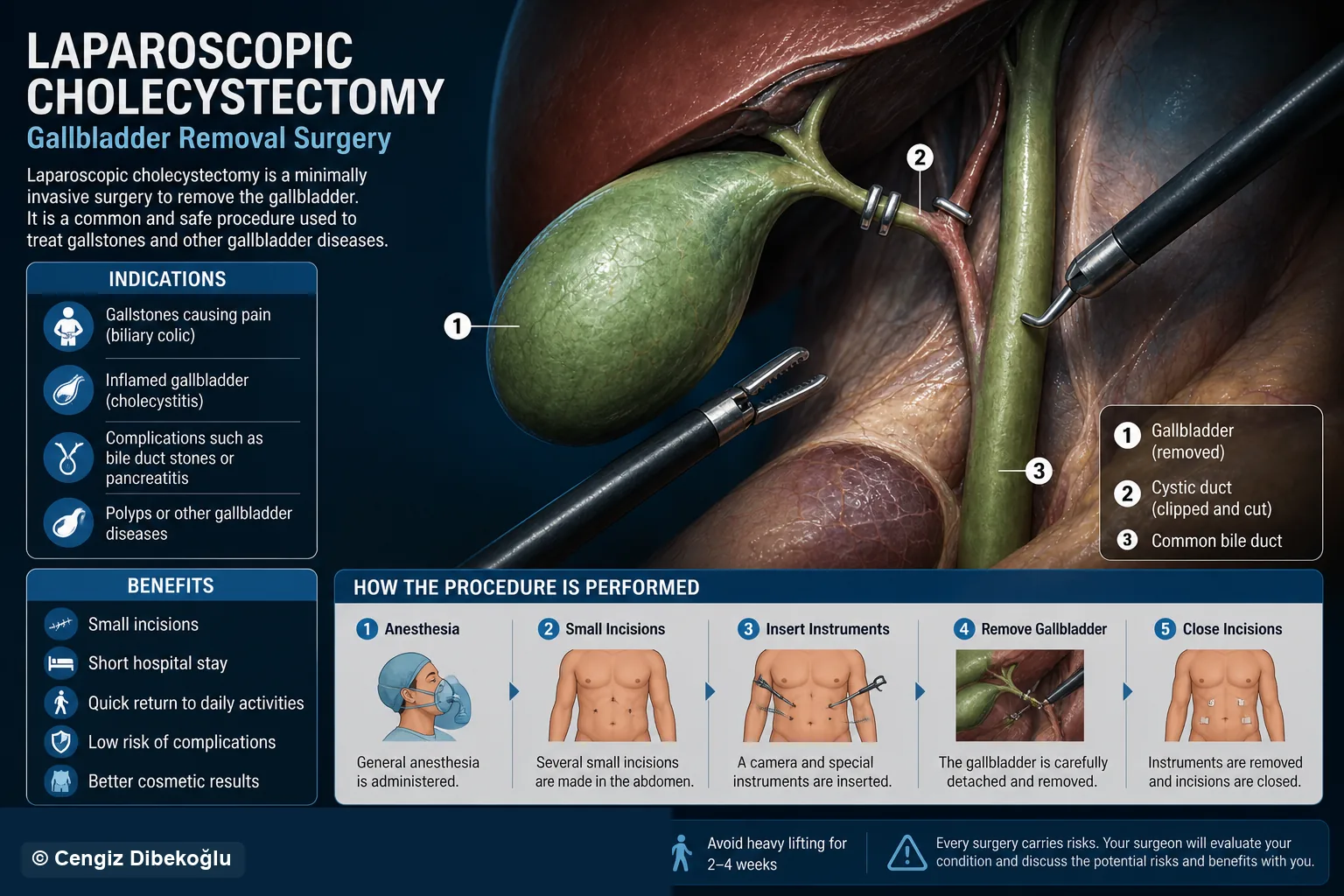 3D diagram: Laparoscopic standard — laparoscopic cholecystectomy