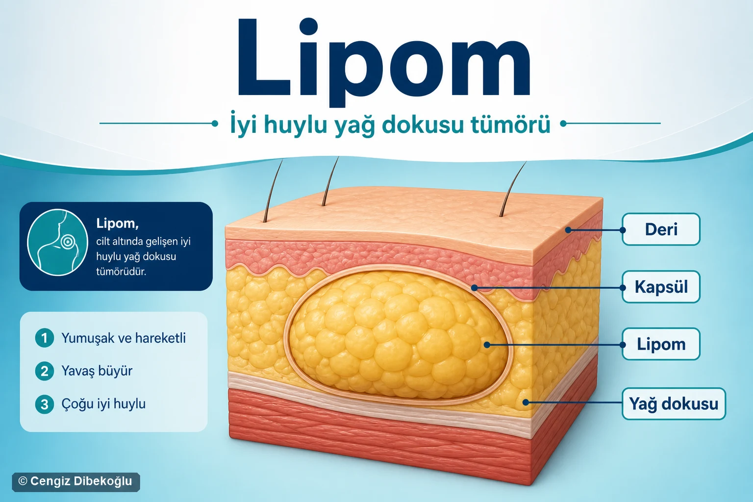 Lipom
