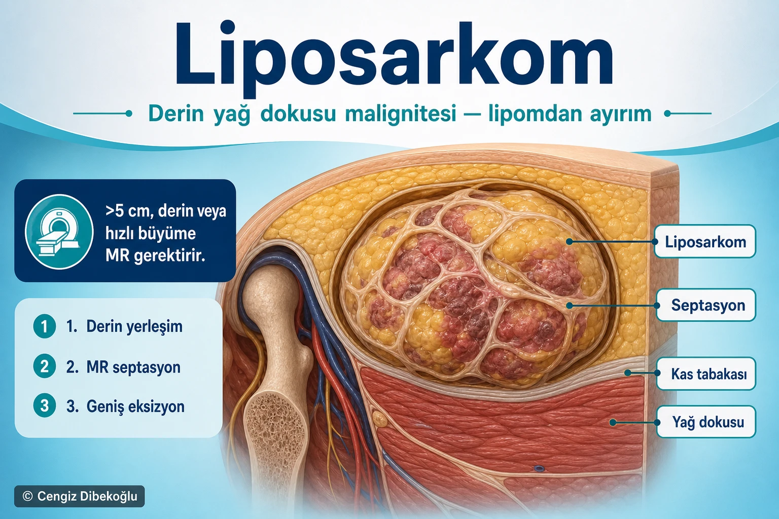 Liposarkom