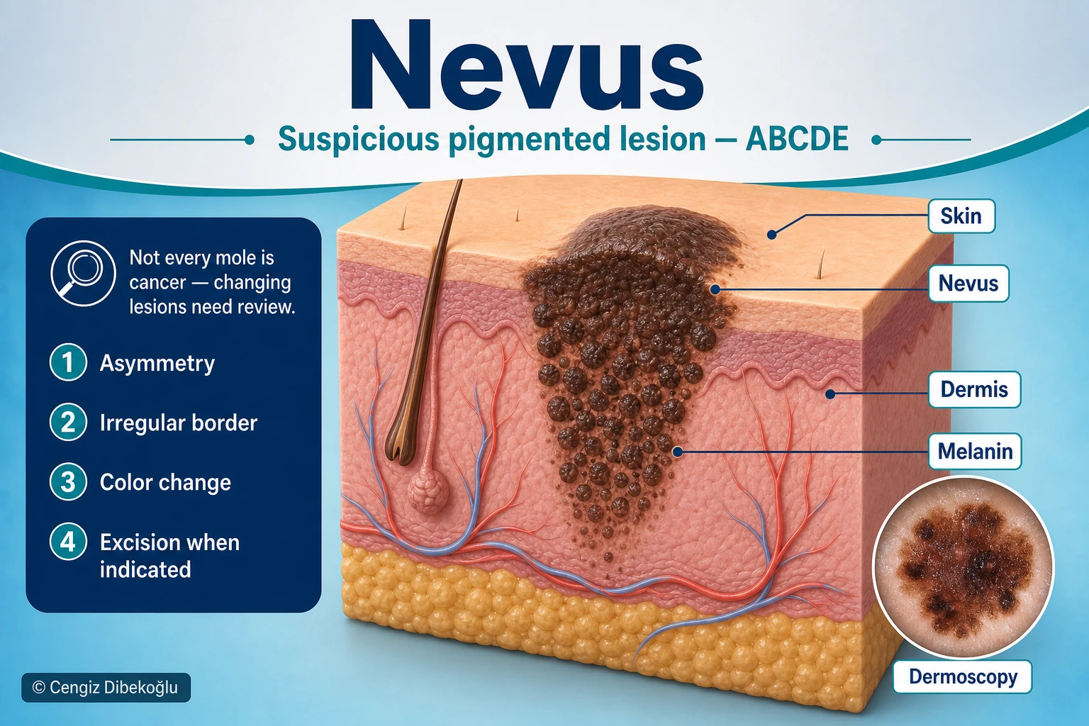 3D diagram: Nevus — ABCDE and excision