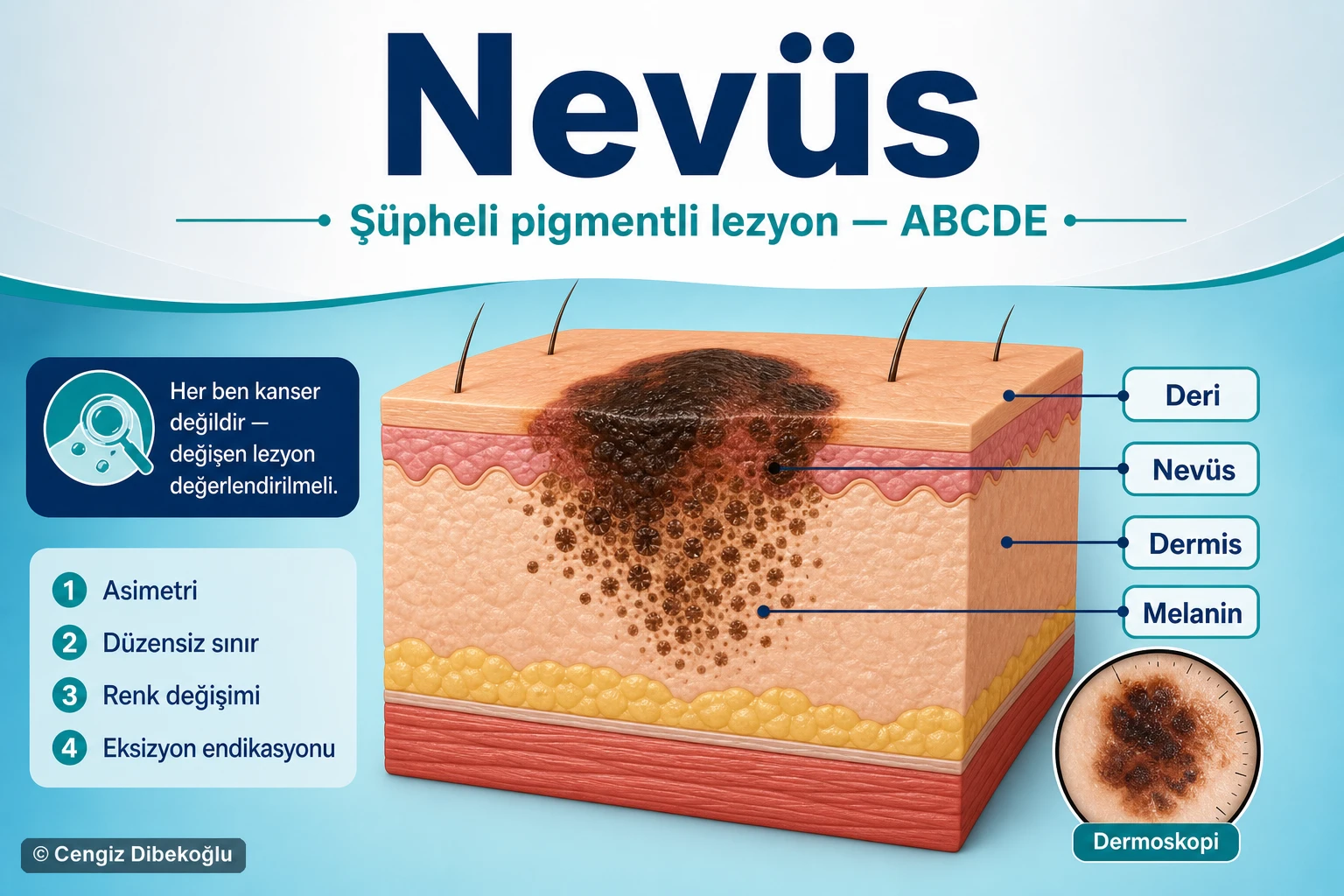 Nevüs