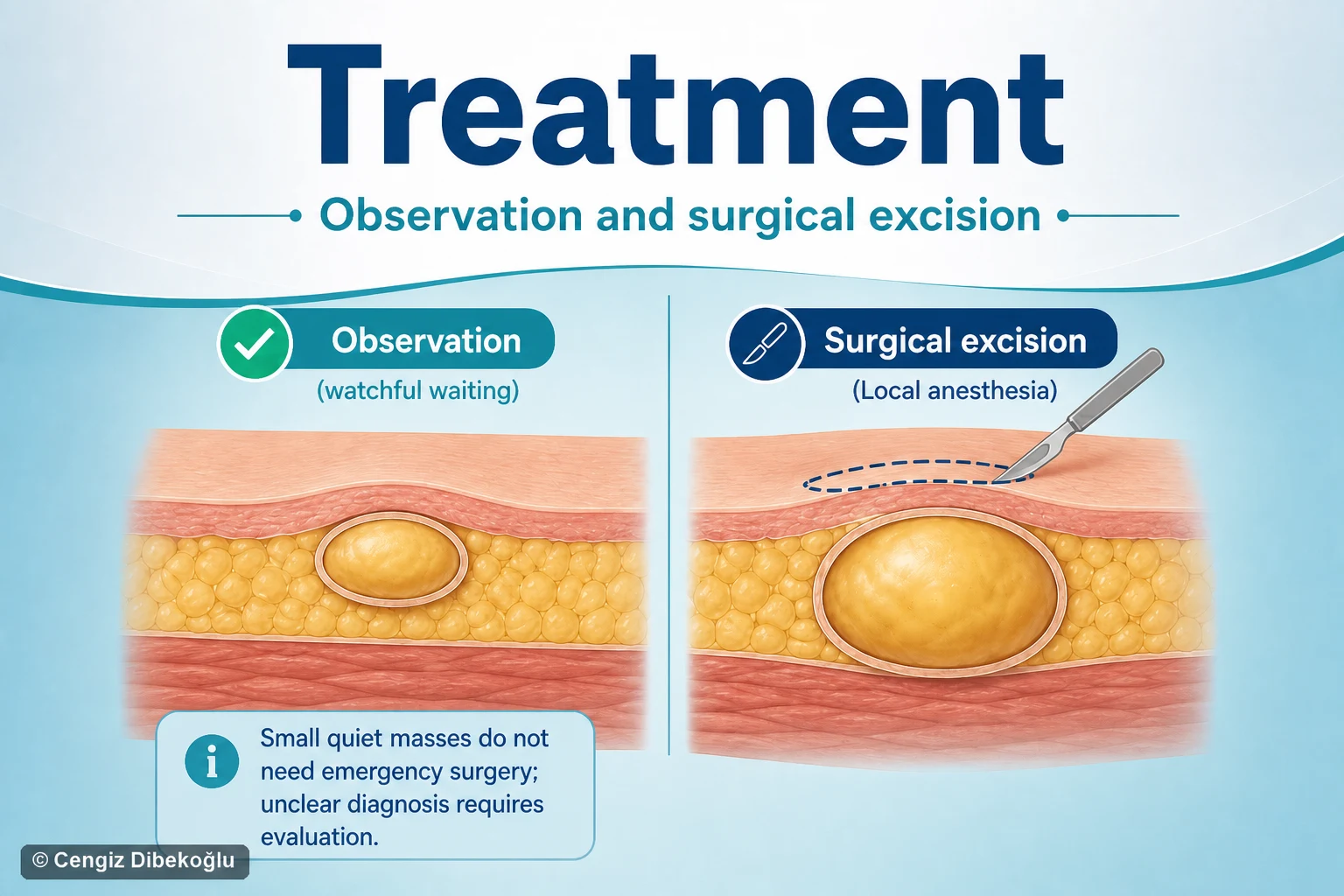 3D diagram: Treatment — observation vs excision